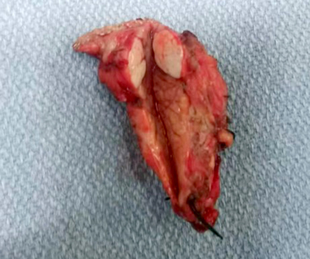 Surgically resected pancreatic tumor, exhibiting a well-defined grayish-white surface with a section area of 1.2×1 cm.