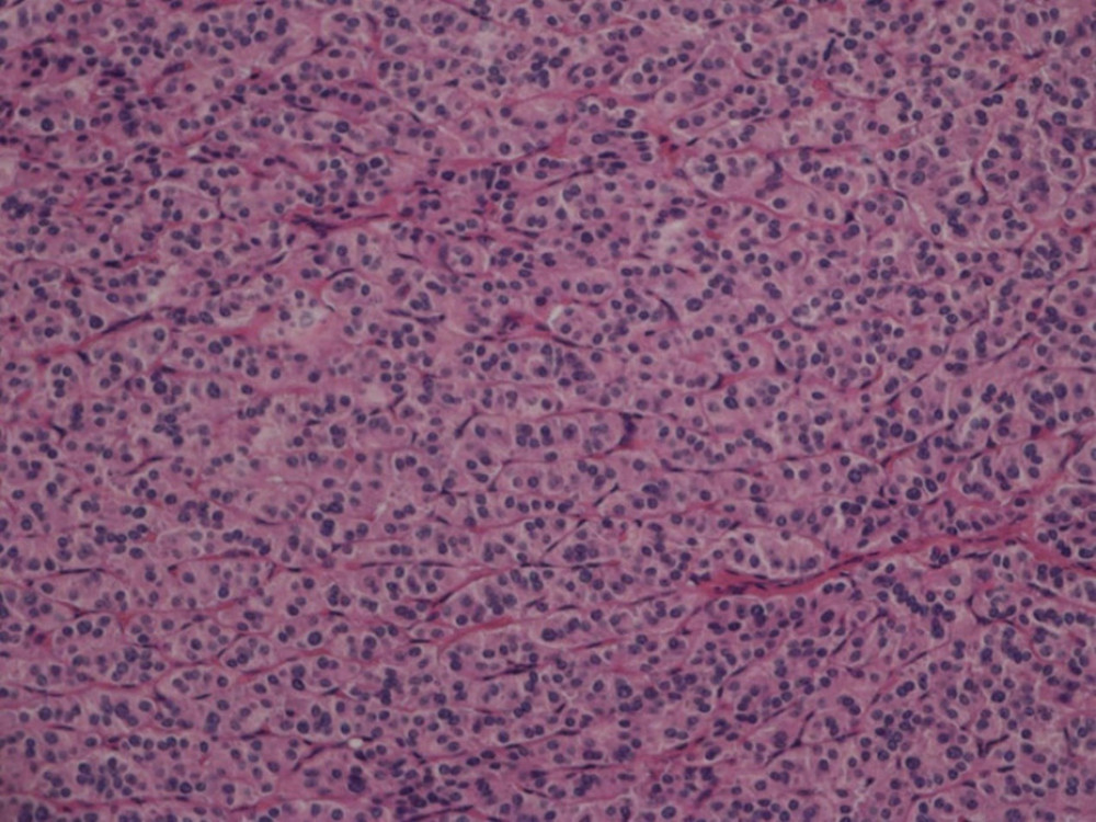 Pathological section of the pancreatic tumor. Hematoxylin and eosin micrographs demonstrate uniform round nuclei and eosinophilic fine granular cytoplasm in the tumor cells. The slide is magnified at 20×10, and the equipment used was the Nikon ECLIPSE 80i.