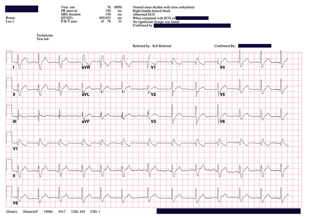 Prior EKG with normal sinus rhythm with sinus arrhythmia and right bundle branch block (RBBB).