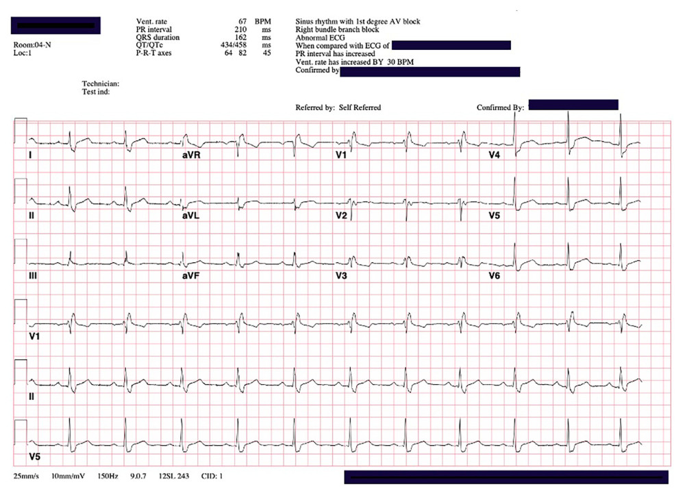 EKG 2 hours after initial EKG. Rate rises after atropine and fluids with new first-degree AV block.