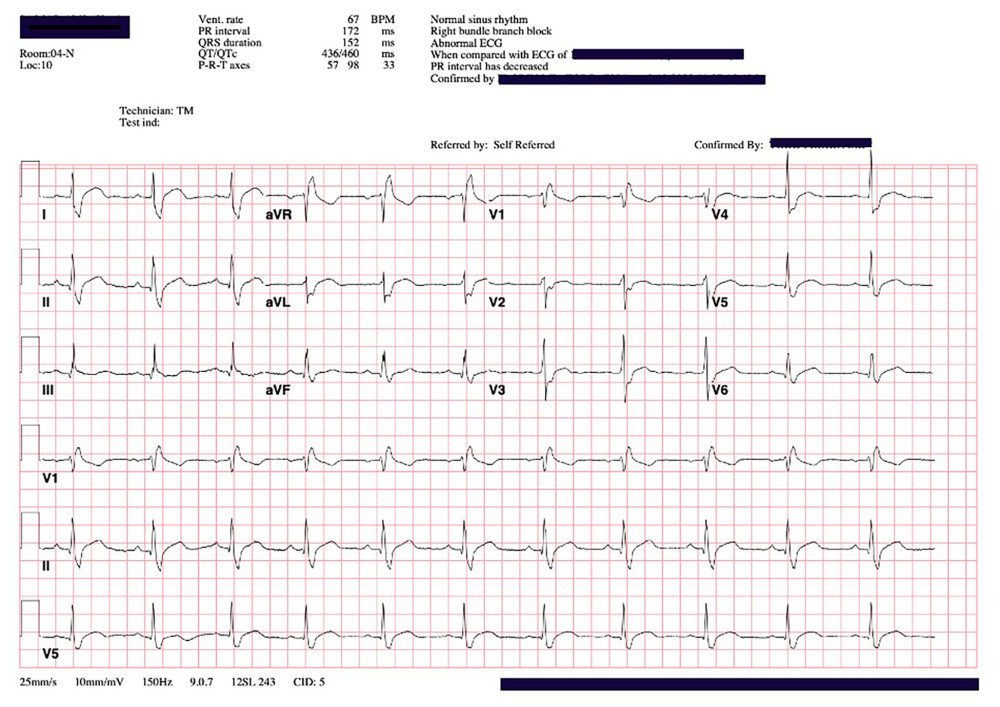 The husband’s EKG 10 hours after initial EKG, now similar to his baseline EKG.