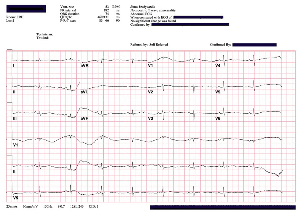 Presenting EKG of the wife, demonstrating sinus bradycardia and T-wave changes.