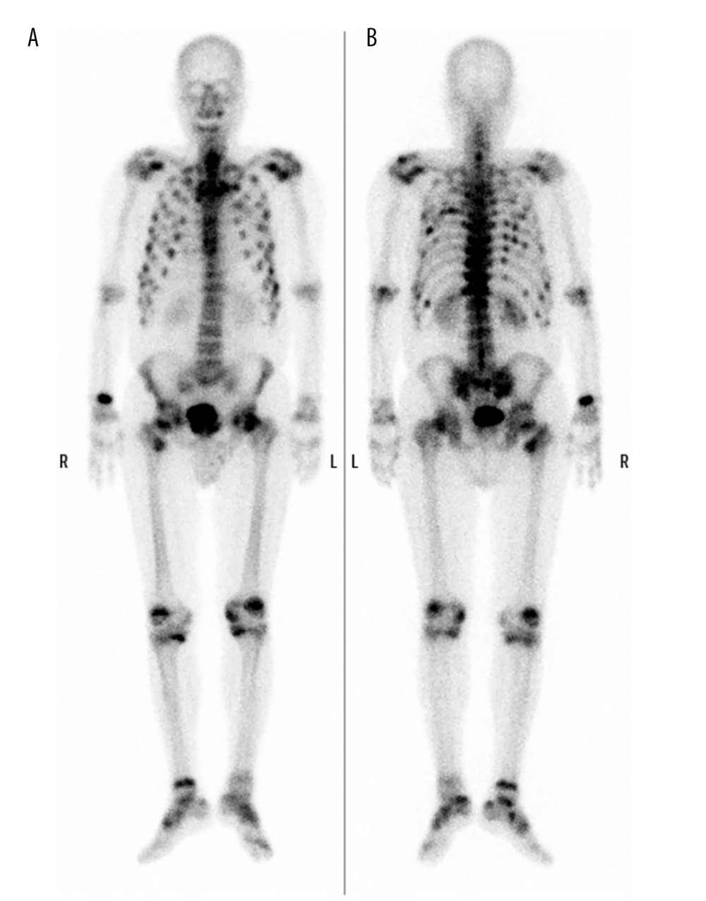 99mTechnetium-hydroxymethylene diphosphate scintigraphy. (A) Anterior view; (B) Posterior view. Multiple accumulations are observed in the bilateral ribs, bilateral proximal femurs, right proximal tibia, distal radius, bilateral sacroiliac joints, and sacrum.