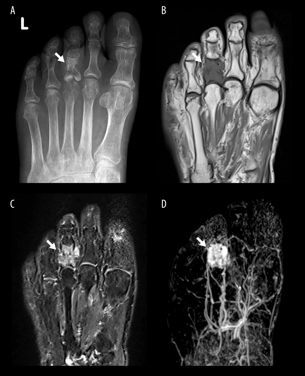 Imaging examinations identifying the tumor responsible for tumor-induced osteomalacia. Radiography reveals destructive changes in the third basal phalanx of the left foot. (A) The cortical bone in the distal third of the left basal phalanx exhibited pervasive expansible alterations and partial deterioration. (B, C) The inner part is replaced by an injury that exhibits a low signal intensity similar to that of the muscle tissue on T1-weighted imaging and a heterogeneous mixed high signal on fat-suppressed T2-weighted imaging. (D) The dynamic magnetic resonance imaging subtraction technique demonstrates robust early enhancement in the marginal areas, followed by gradual enhancement of the inner area.