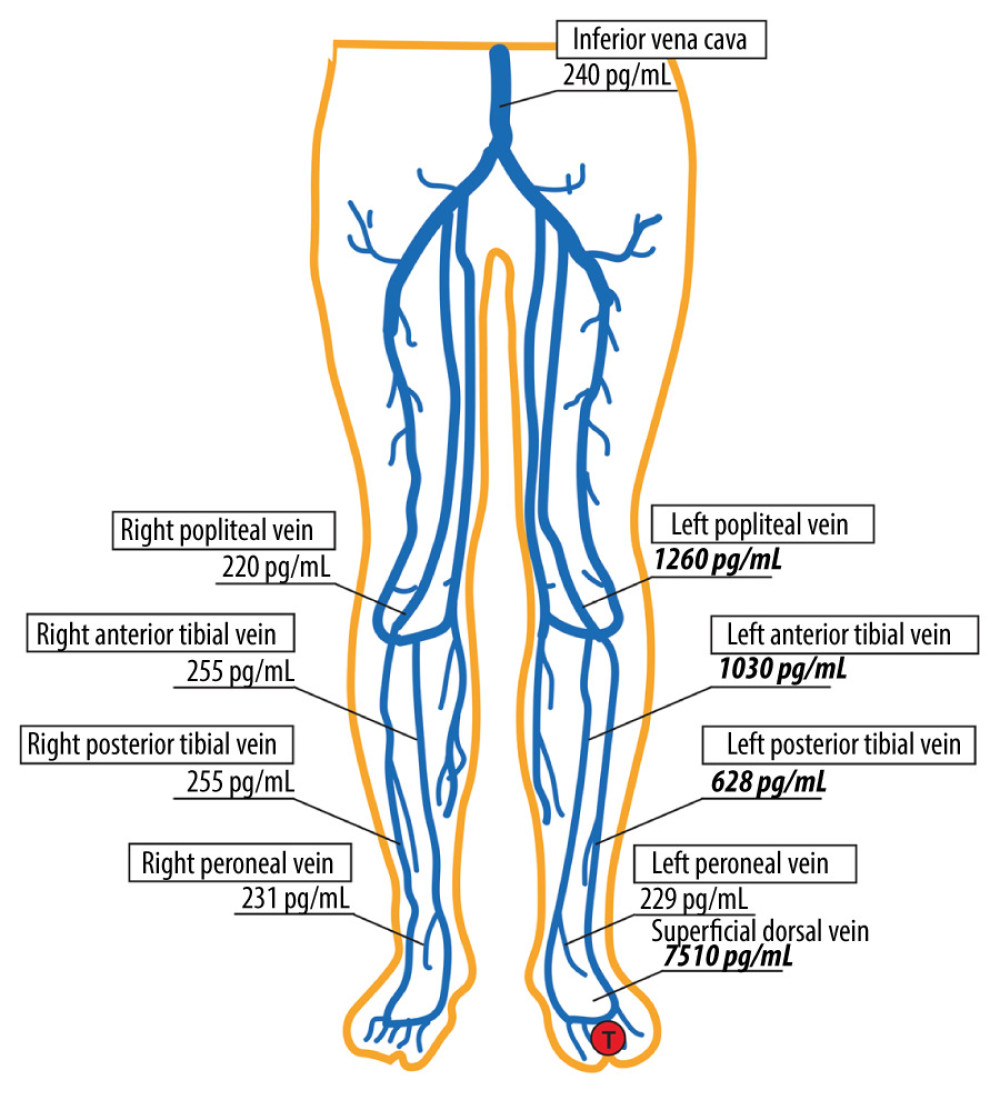 Results of conventional venous sampling examination and superficial vein sampling. Blood sample collection locations and intact FGF-23 (pg/mL) levels. GF-23, fibroblast growth factor-23.