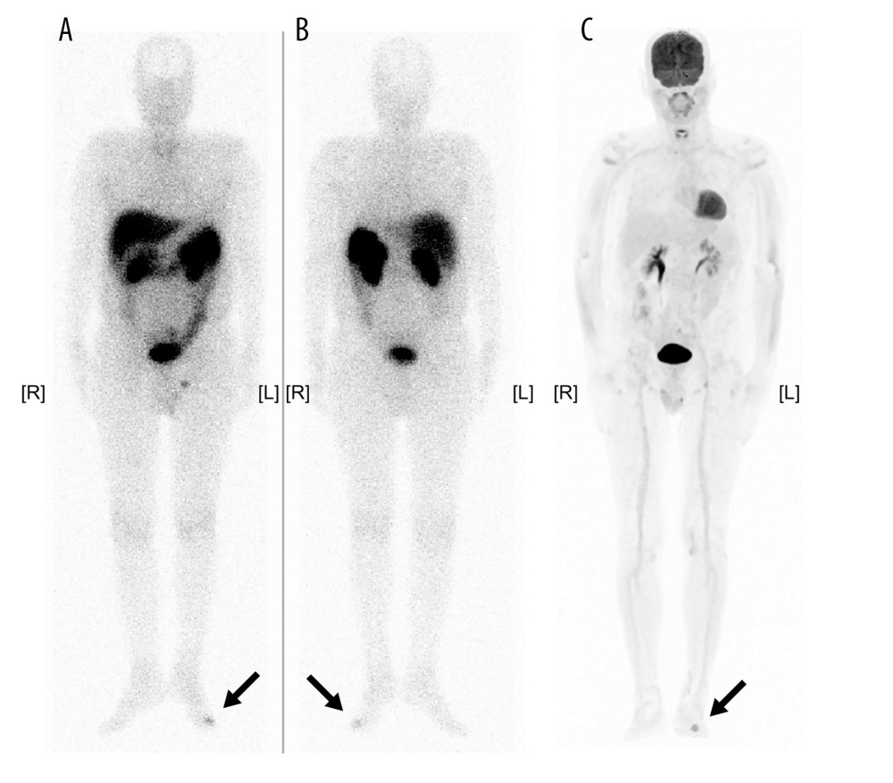 Octreotide scintigraphy and FDG scintigraphy. (A) FDG scintigraphy. (B, C) Octreotide scintigraphy. Abnormal accumulation in the left third basal phalanx (arrows) along with physiological accumulation manifested in the renal, urinary, and gastrointestinal systems. FDG – 18F-fluorodeoxyglucose.