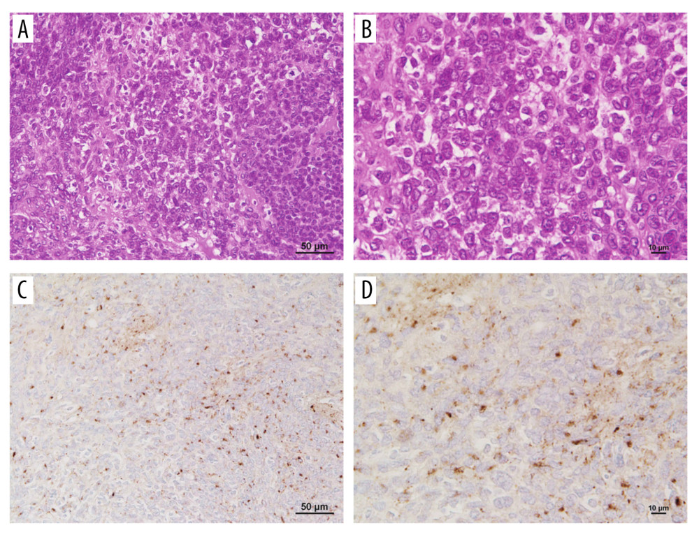 Pathological findings. (A, B) Hematoxylin and eosin staining. The proliferation of spindle-shaped cells can be observed; however, no signs of malignancy were detected: (A) low magnification; and (B) high magnification. (C, D) Immunostaining with an anti-FGF-23 antibody (AdipoGen Life Sciences, CA, USA) shows scattered FGF-23-positive cells: (C) low magnification; and (D) high magnification. FGF-23 – fibroblast growth factor-23.