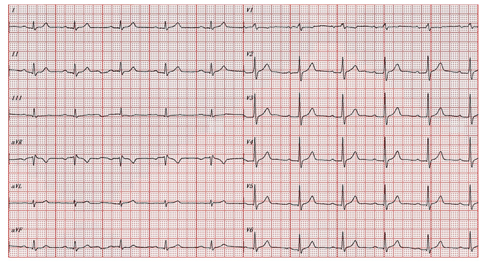 Resting 12-lead electrocardiogram showing an incomplete right bundle branch block with a PR interval of 232 ms and a QRS duration of 108 ms (paper speed 25 mm/s).