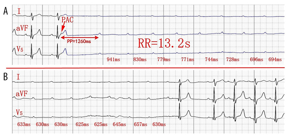 (A, B) Continuous recording: The 24-h Holter recording revealed apparently normal atrioventricular 1: 1 conduction before the transient episode of third-degree atrioventricular block, which was triggered by a nonconducted premature atrial contraction and the subsequent P-P pause of 1260 ms, leading to a ventricular asystole of 13.2 s (paper speed 25 mm/s).