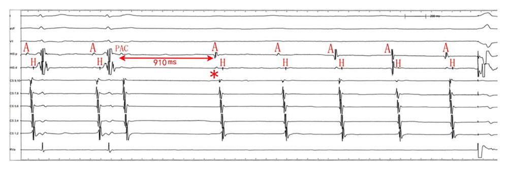 The nonconducted premature atrial contraction triggered another transient episode of third-degree atrioventricular block, and ventricular asystole was terminated by pacing. The long P-P pause and the block of the second atrial impulse (marked as *) created a linking phenomenon that persisted for 5 cycles. The His potential was recorded, indicating that the block site was distal, at the infra-His-Purkinje system (paper speed 100 mm/s). HIS – His bundle; CS – coronary sinus; RVa – right ventricle