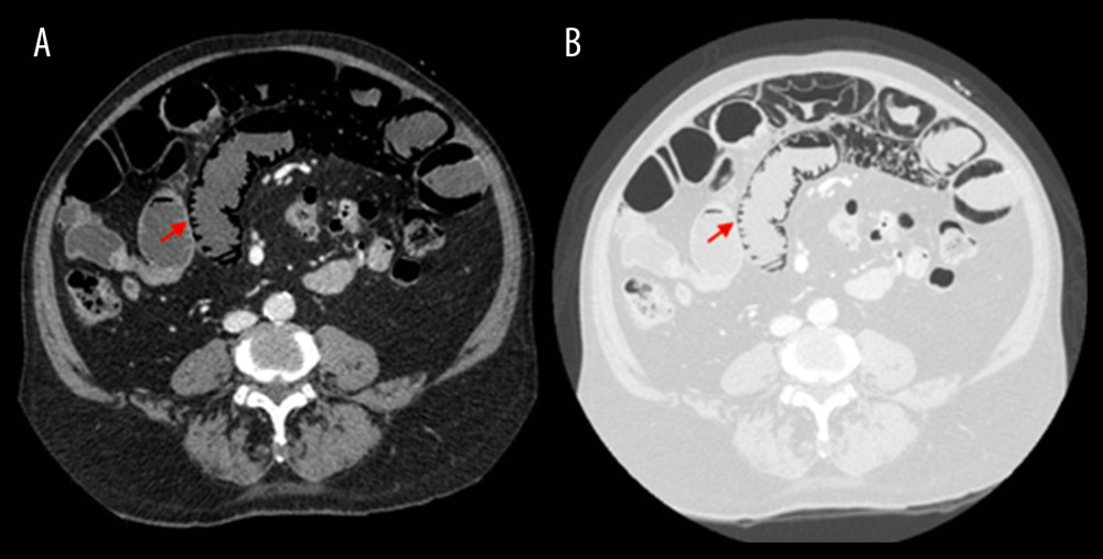 Pneumatosis intestinalis image (red arrow) on abdominal CT scan: intravenous phase and lung window.