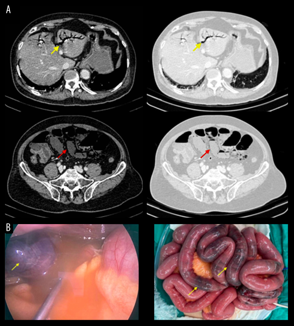 (A) Pneumatosis intestinalis image in the left portal vein (yellow arrow) and small intestine wall (red arrow) on abdominal CT scan: intravenous phase and lung window. (B) Intraoperative finding of necrosis of the small intestine without thrombosis.