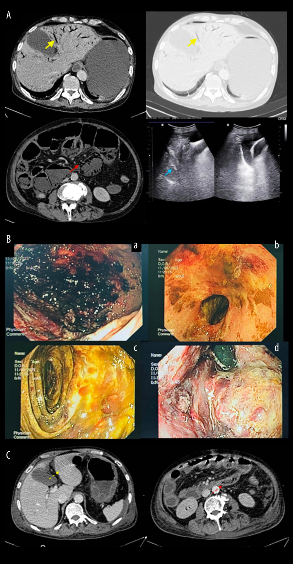 (A) Gas presence in the portal vein (yellow arrow) and intestinal wall (red arrow) detected by abdominal CT scan and sign of scattered “comet-tail” artefacts on abdominal ultrasound (blue arrow). (B) Mucosal bleeding of gastric body (a) and pyloric antrum (b), mucosal ischemia of superior part of duodenum (c), and cardia (d). (C) Gas bubbles in the portal vein and intestinal wall disappeared after 3 days of resuscitation treatment (yellow and red dashed arrow).