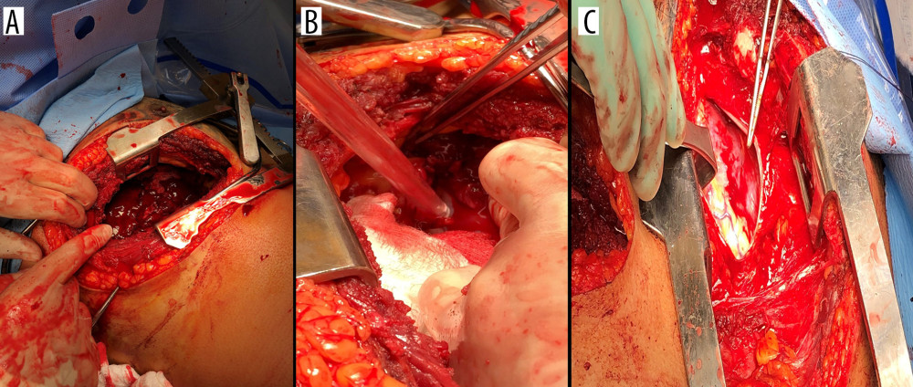 Case 1: Right thoraco-abdominal stab wound, laceration to right central tendon of diaphragm, right ventricle epicardium, through-and-through laceration of the right lobe of the liver (Grade IV), Grade III duodenal laceration. Index surgery where the hemothorax with clots is shown in (A), central tendon diaphragm in (B), and epicardia laceration in (C).