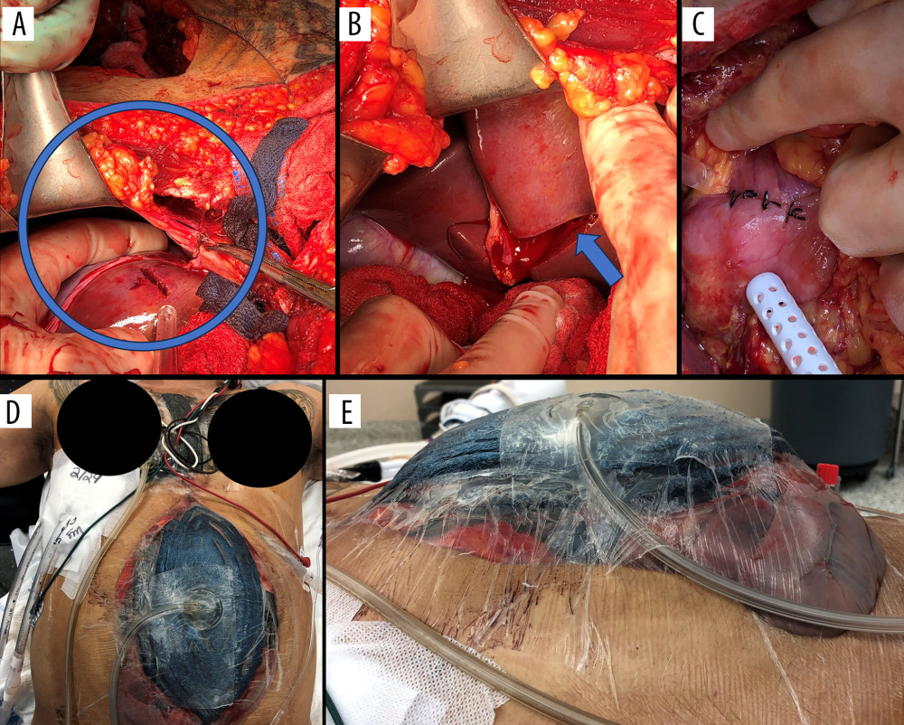 Case 1: Index surgery where (A, B) depict the through-and-through Grade V liver stab wound (circled in A, arrow in B), and (C) depicts the wound post-repair. The repair of Grade III duodenal injury and Grade IV liver laceration with negative-pressure wound therapy and temporary abdominal wound closure (NPWT/TAC) is shown in (D), and (E) shows the clinical evidence of abdominal compartment syndrome (ACS).