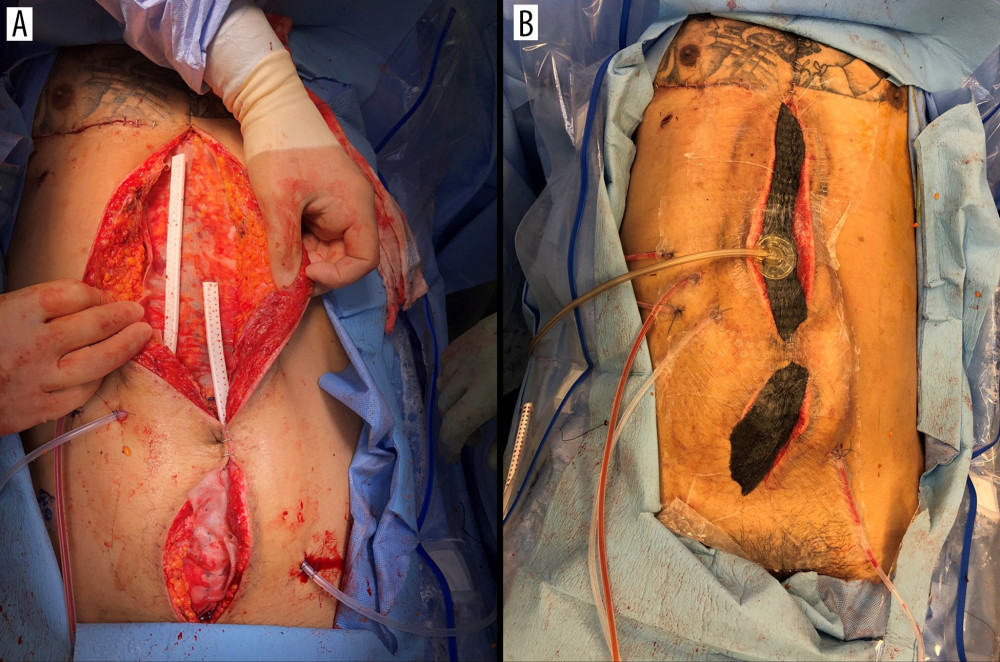 Case 1: On postoperative day/hospital day (PO/HD) 9, the patient underwent resection segment of necrotic liver (Cuinaud Segment IIB) and repaired using a Cellan-Jones omental patch to the liver/duodenum. (A) Depicts the myocutaneous flap advancement with primary fascial closure (B).