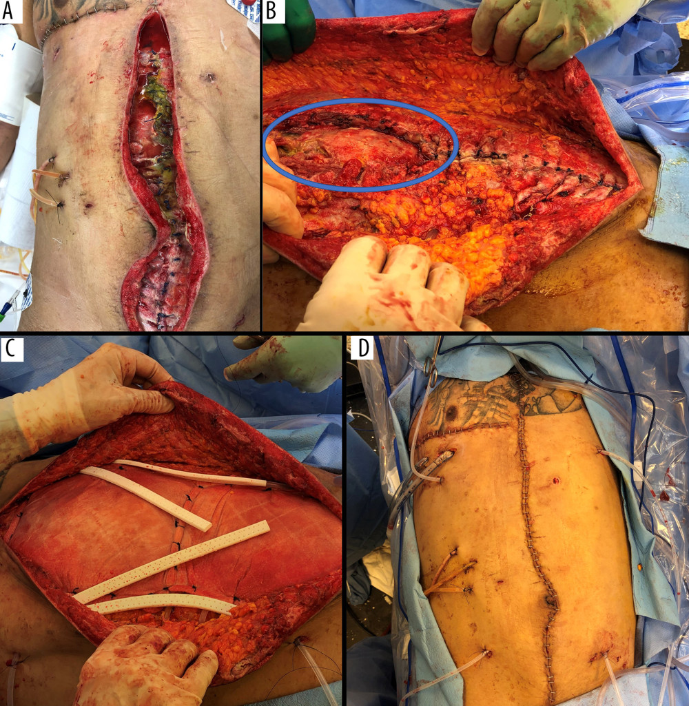 Case 1: On hospital day 14, the patient’s upper midline incisional closure dehisced (A) due to bile auto-digestion of native tissue. The remaining defect, approximately 10×10 cm (circled in B), after debridement and partial closure is shown in (B). Following debridement of the necrotic fascia and myocutaneous advancement of the abdominal wall, (C) two 8-layer OviTex 2S Resorbable RTMs (20×20 cm and 20×16 cm, respectively) were applied to the wound with overlay placement and (D) myocutaneous flap advancement followed by abdominal wall closure.