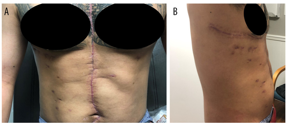 Case 1: On clinic follow-up (29 days after discharge home, 58 days after index surgery), the physical exam showed no evidence of ventral hernia (A, B).