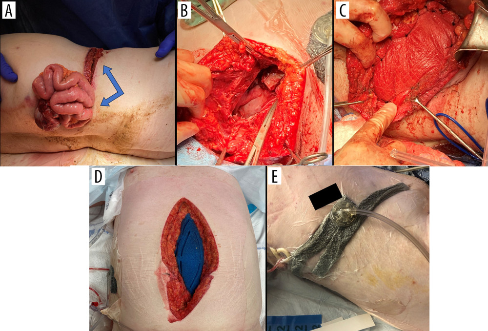 Case 2: Open skull fracture with exposed brain, major lacerations to the shoulder, right hemithorax and abdomen causing a large right-flank hernia (A) due to an automated trencher accident. Arrows in (A) indicate the thoraco-abdominal penetrating injury, large and deep abdominal subcutaneous laceration, and eviscerated colon and small bowel. A right hemicolectomy with primary anastomosis was performed where (B) shows the right-flank defect hernia (20×15 cm defect), (C) OviTex 1S Resorbable RTM (6-layer, 10×20 cm) used as a sublay repair for the right-flank hernia, (D) open abdomen dressing, and (E) negative-pressure wound therapy and temporary abdominal closure (NPWT/TAC) applied within the open abdomen and the thoraco-abdominal flank incision.