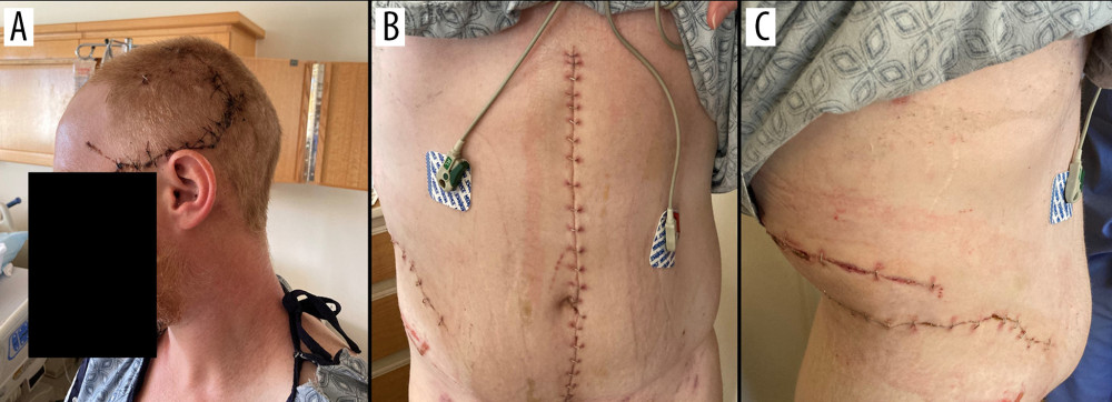 Case 2: The patient at time of discharge on HD 13 with progressive improvement in aphasia and overall normal recovery (A–C).