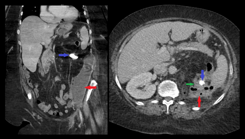 Retro-gastric abscess and peri-splenic component extending in the left parieto-colic gutter to the left iliac fossa (red arrow). The blue arrow is pointing to the staghorn lithiasis, and the green arrow indicates the left atrophic kidney.