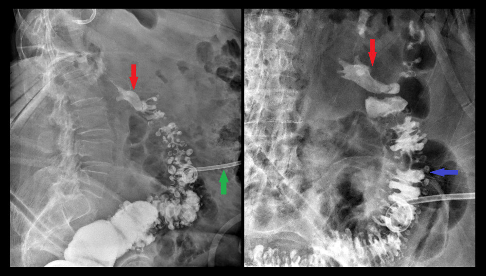 Images of the colonic enema showing no leakage of contrast material into the urinary system. The red arrow is pointing to the staghorn calculus. The blue arrow indicates the colon with a lot of diverticula, and the green arrow shows the radiological drain.