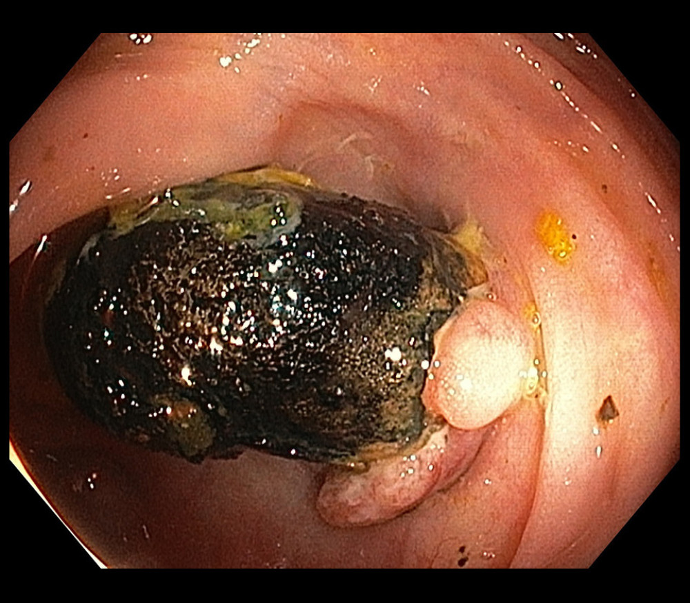 View of the coralliform lithiasis protruding within the colonic lumen at the colonoscopy.