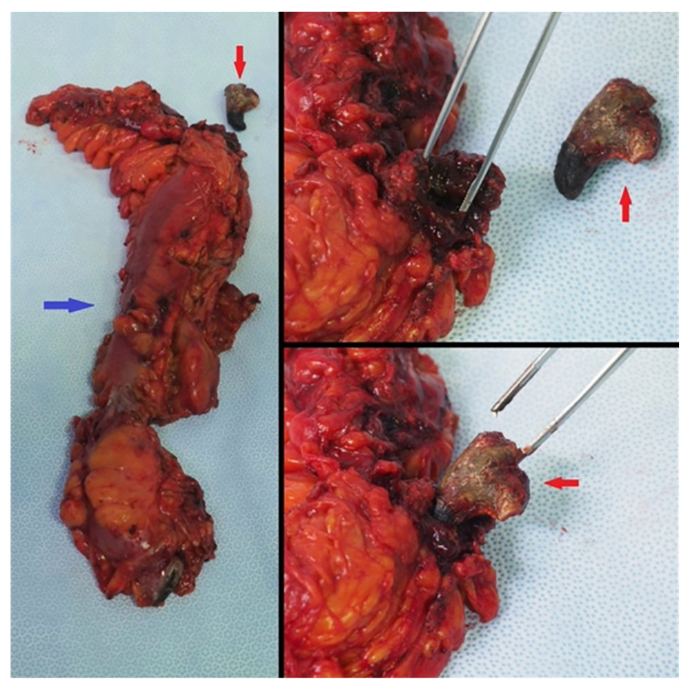 Pictures of the colonic resection with the staghorn lithiasis. The red arrow is pointing to the staghorn calculus. The blue arrow shows the left colon.