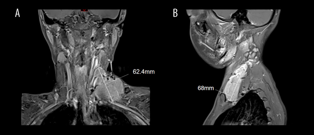 Neck MRI of Case 1. An irregular lobulated lesion (68×71×28 mm) in the left neck-left thoracic cavity, with uneven signal intensity in the mass, predominantly low signal on T1WI (A), and high signal on T2WI. (B) Scattered low signal areas were seen internally on T1WI and T2WI, with visible vascular flow voids passing through.