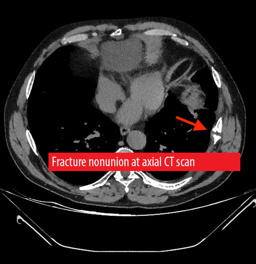 Axial computed tomography scan of the nonunion; view of the nonunion in the axial plane.