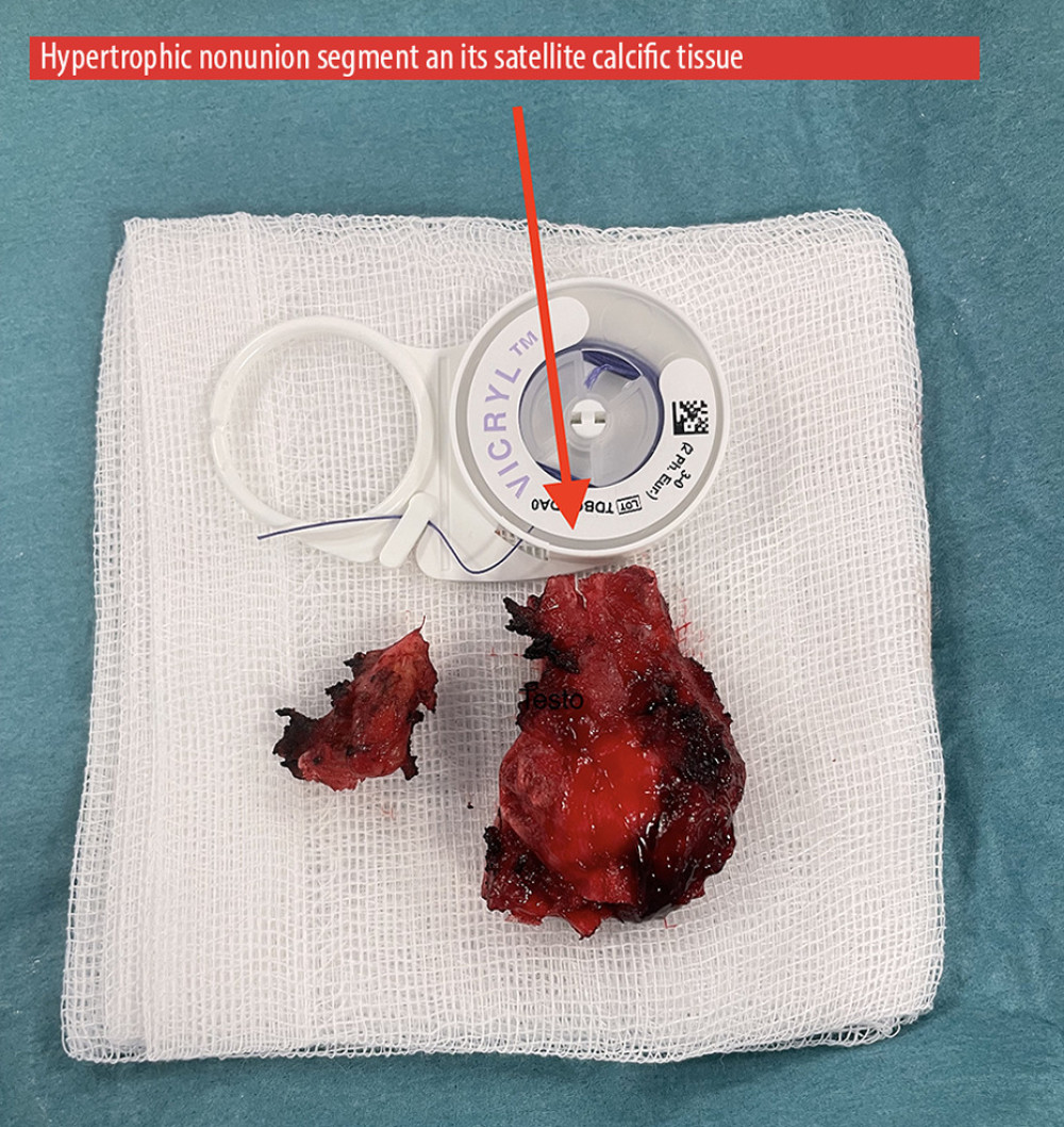 The specimen. This picture shows the hypertrophic nonunion segment after removal and its satellite interposition tissue. Both are indicated by the red arrow.