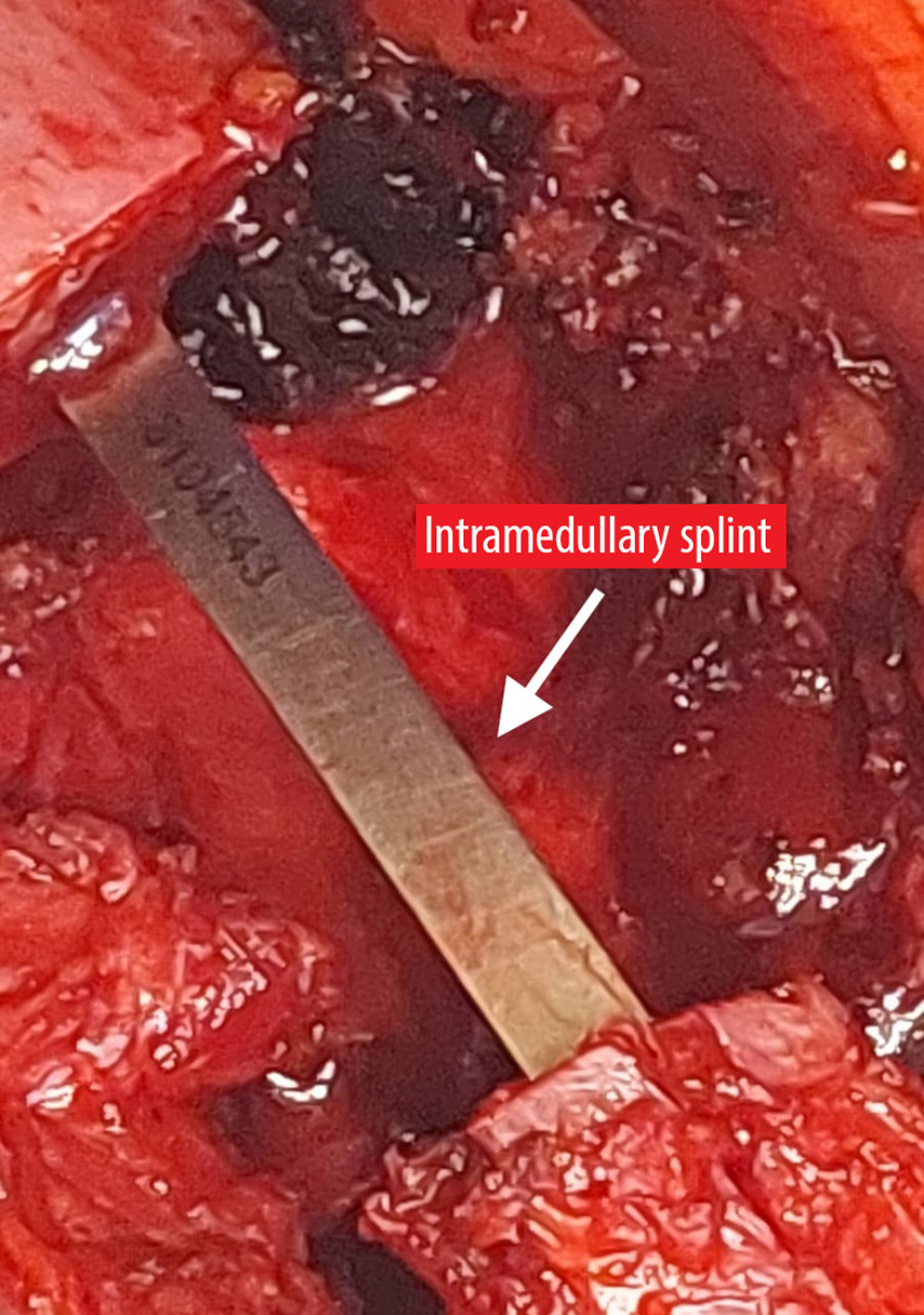 Rib fixation. We repaired the rib by introducing a single intramedullary splint as indicated by the white arrow.
