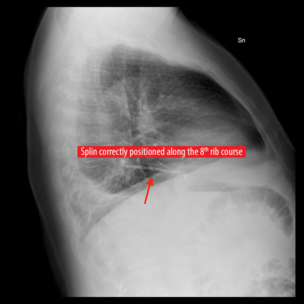 First postoperative X-ray showing correct splint position along the 8th rib projection, as indicated by the arrow.