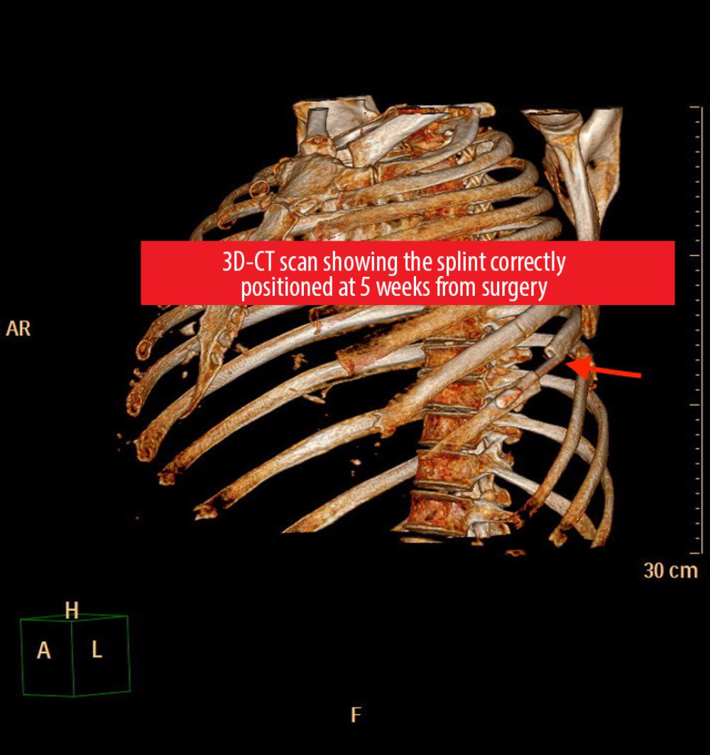 Long-term computed tomography (CT). At 6 weeks following surgery, a CT scan confirmed the correct splint position, as indicated by the arrow.