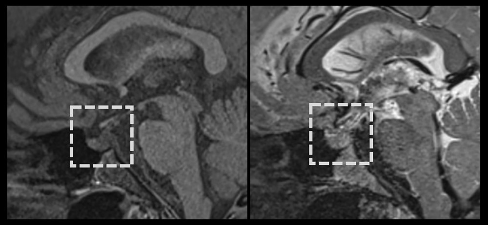 Head sagittal magnetic resonance imaging (MRI): right (T1-weighted MRI) left (T2-weighted MRI). Loss of posterior lobe signal on T1-weighted MRI (dashed square) indicates the possible central diabetes insipidus.