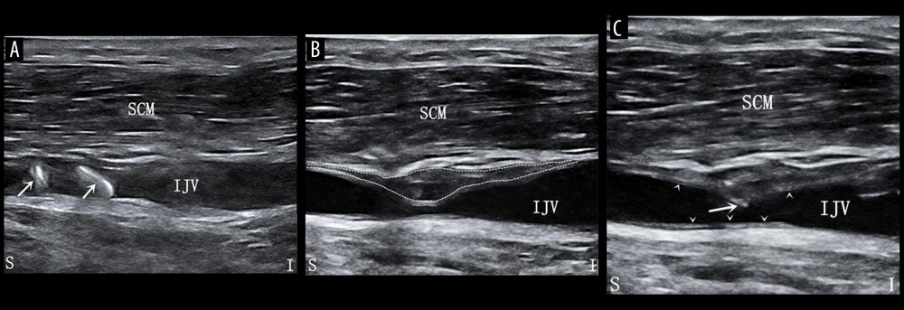 (A) Ultrasound depiction during internal jugular vein puncture, illustrating the observation encountered during guide wire insertion. The longitudinal ultrasound image reveals that after the guide wire penetrated the outer membrane of the internal jugular vein, a section of the wire wrapped around the blood vessel wall. The long white arrow denotes the central venous puncture guide wire. S – superior; I – inferior. (B) Representation of ultrasound conducted when insertion after guide wire removal proved challenging. The image displays a “pseudolumen” (indicated by the white dashed line) situated between the outer and inner-middle membrane of the internal jugular vein, with discernible fluid-filled dark areas within. IJV – internal jugular vein; SCM – sternocleidomastoid muscle. White dashed line represents the “pseudolumen” formed in the blood vessel wall after removing the guide wire. S – superior; I – inferior. (C) Ultrasound-guided intraplane jugular venocentesis catheter placement. IJV – internal jugular vein; SCM – sternocleidomastoid muscle. White arrowheads indicate vascular intimal calcification; the long white arrow represents the central vein puncture needle.