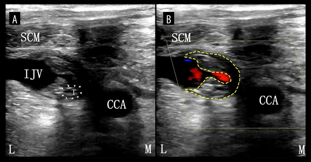 (A, B) Ultrasound images depicting thrombosis formation after internal jugular vein puncture and catheterization on day 4. IJV – internal jugular vein; SCM – sternocleidomastoid muscle; CCA – common carotid artery; T – catheter; L – lateral; M – medial. Yellow dotted line area signifies hypoechoic crescent internal jugular vein thrombosis.