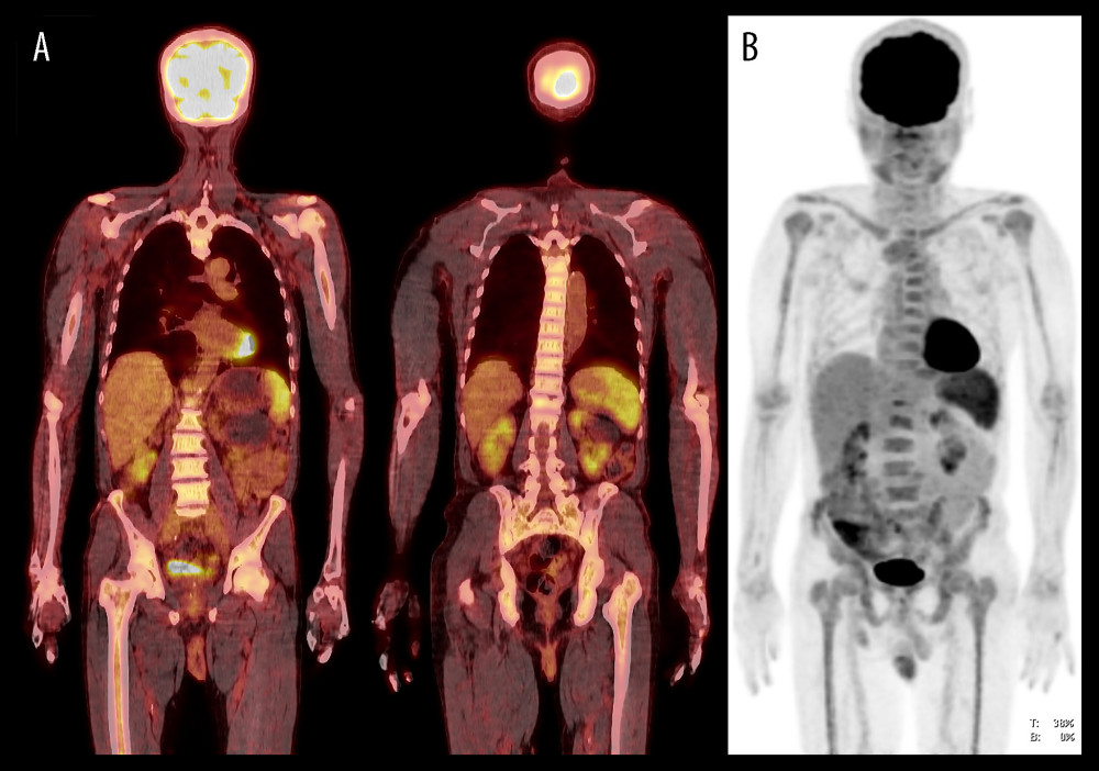 Imaging of initial recurrence on October 22, 2021. (A) Fluorine-18-fluorodeoxyglucose positron emission tomography/ computed tomography (18F-FDG PET/CT) scan shows diffuse homogenous low bone marrow uptake (BMU) (maximum standardized uptake value (SUVmax) 3.63 in the spine and 3.22 in the pelvis, with normal liver SUVmax 2.87). (B) Maximum intensity projection (MIP) image shows homogeneously distributed enhanced BMU.