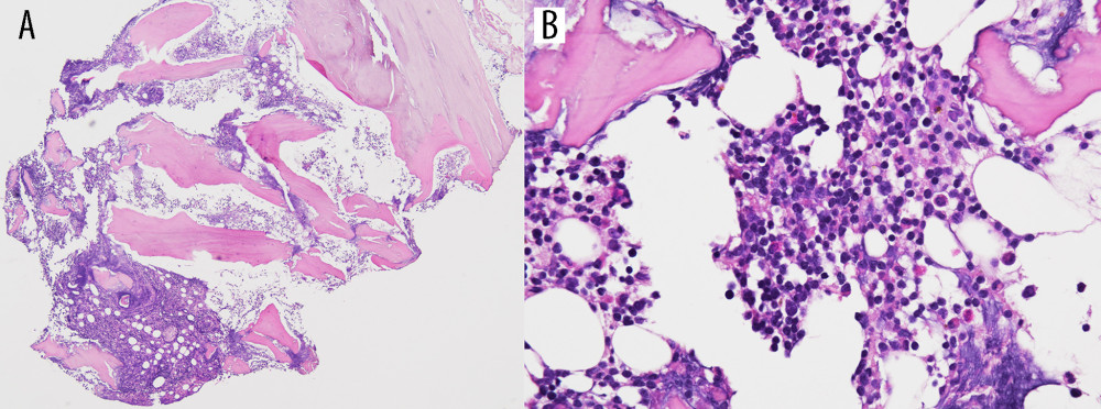 Histopathological findings of initial recurrence on October 27, 2021. (A, B) Hematoxylin and eosin (H&E) staining of bone marrow shows hypercellularity with magnified diffuse infiltration of small to medium-sized lymphoma cells. Objective magnification A ×40 and B ×400.