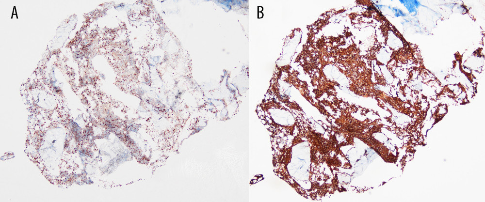Histopathological findings of initial recurrence on October 27, 2021. (A, B) Immunohistochemical (IHC) staining of bone marrow reveals CD3(-) and CD20(+).