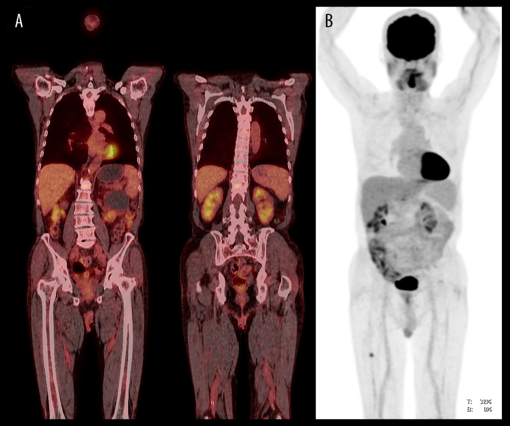Imaging after treatment, on June 7, 2022. (A) Fluorine-18-fluorodeoxyglucose positron emission tomography/computed tomography (18F-FDG PET/CT) scan shows subtle 18F-FDG uptake (maximum standardized uptake value (SUVmax) 2.69 in the spine and 1.02 in the pelvis). (B) Maximum-intensity projection (MIP) image shows no obvious bone marrow uptake (BMU) compared to Figure 1.