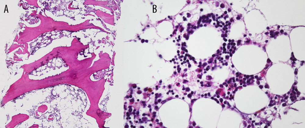 Histopathological findings after treatment on June 27, 2022. (A, B) Hematoxylin and eosin (H&E) staining of bone marrow shows normocellularity with normal hematopoietic cells without evidence of lymphoma involvement. Objective magnification A ×40 and B ×400.