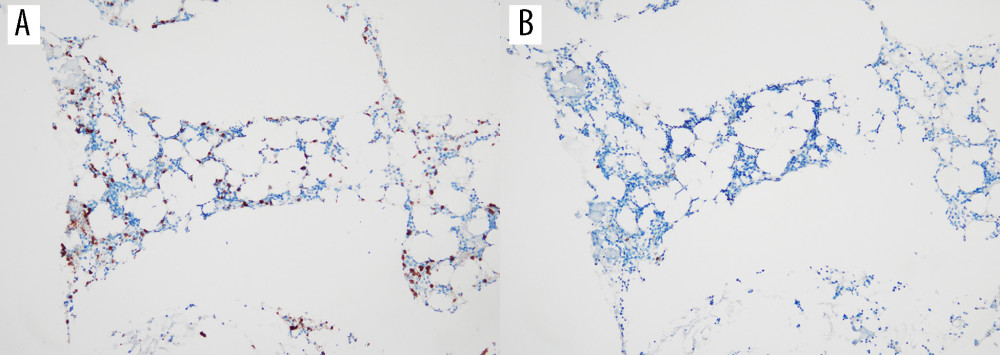 Histopathological findings after treatment, on June 27, 2022. (A, B) Immunohistochemical (IHC) staining of bone marrow reveals CD3(-) and CD20(-).