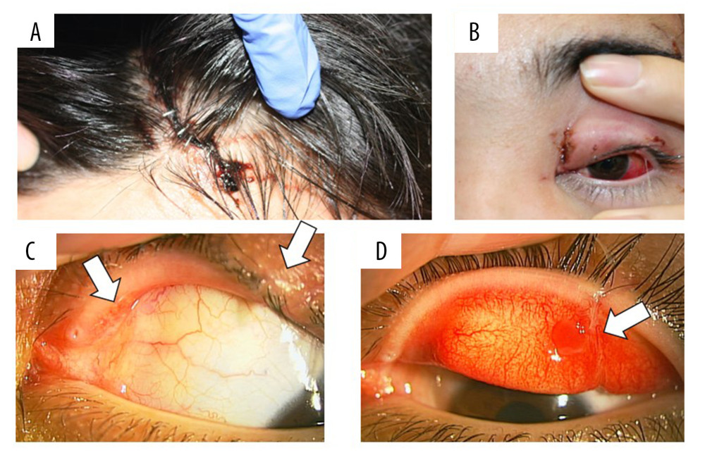 At the time of the first visit to the previous physician, 3 days after the injury: (A) A sutured wound is observed extending from the forehead to the scalp. (B) Bite wounds are observed on the outer side of the left eyebrow and the nasal and temporal sides of the left upper eyelid. The left upper eyelid is swollen and cannot open by itself. Subconjunctival hemorrhage is observed in the left eye, but there is no abnormality within the eye. At the time of the initial visit to our clinic, 2 months after the injury: (C) Scarring is seen on the nasal side of the bulbar conjunctiva and the temporal side of the upper eyelid. (D) Scar formation is seen on the temporal side in the blepharoconjunctiva.