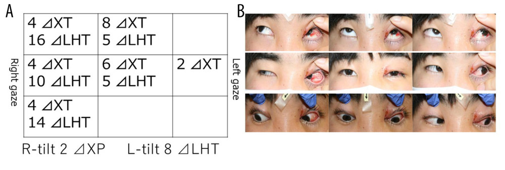 Results of ocular alignment and ocular motility, 5 days after injury. (A) Results of alternate prism cover test (APCT) for farocular alignment. The right gaze shows aggravation of left hypertropia relative to the primary position. The left hypertropia improves with head tilt to the right and worsens with head tilt to the left, and the Bielschowsky head-tilt test result is positive with tilt to the left. Parks’ three-step test was consistent with a diagnosis of superior oblique palsy in the left eye. APCT results showed a negative complication of pseudo-Brown syndrome. (B) No obvious limitation of ocular motility. There is no limitation of elevation in the adduction of the left eye.