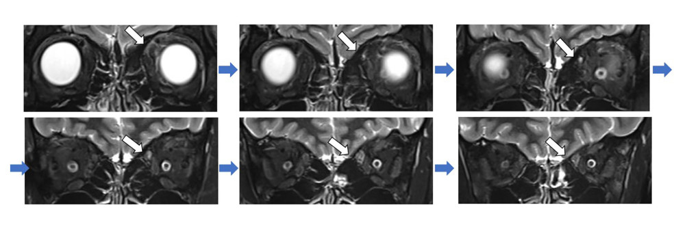 Orbital short tau inversion recovery (STIR) magnetic resonance image (MRI) 5 days after injury. This coronal section STIR MRI of the orbit presents anterior to posterior alignment. The slice width is 3 millimeters. The MRI reveals a continuous high-signal region extending from the nasal area of the upper eyelid to the trochlea and the superior oblique muscle belly of the left eye (white arrow).