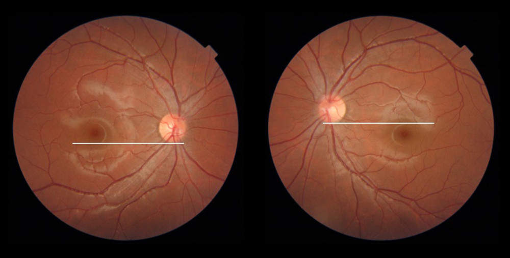 Fundus photograph showing extorsion of the left eye. In normal patients, the macula is situated between the center and the inferior margin of the optic disc. The fundus photograph of this patient shows that the macula is positioned below the inferior margin of the optic disc in the left eye, indicating external extorsion of the left eye.
