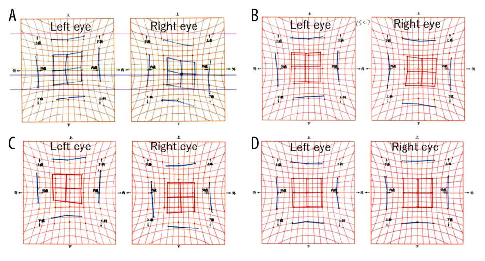 Results of preoperative and postoperative Hess screen chart. (A) Five days after the injury. (B) Two months after the injury. (C) Seven months after the injury. (D) Six months after surgery. Hess screen chart at the time of the first visit to the previous doctor showed limitation in depression during adduction, which evolved over time, and no longer showed the typical form of superior oblique palsy. Postoperatively, vertical and torsional strabismus both improved on the Hess screen chart.