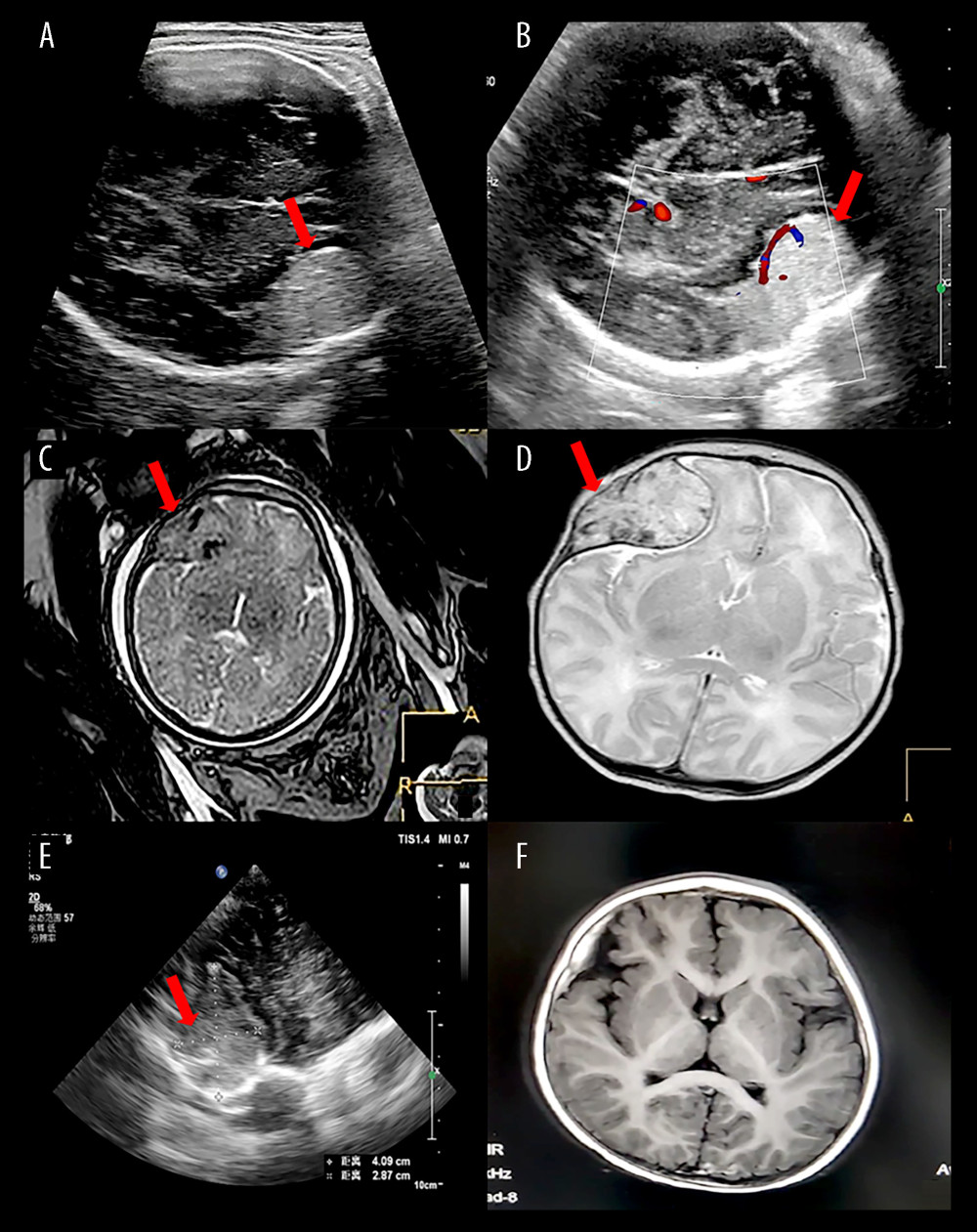 Gray-scale (A) and color Doppler (B) ultrasound images of the case at 38 weeks revealed a 32×22 mm right frontal heterogeneous mass with various focal hypoechogenic (red arrow). A few small hyperechogenic foci can be observed in the lesion and a wide base of case can be detected close to frontal bone. (C) Axial T2-weighted image of case at 38 weeks on MRI. The mass appears hyperintense of the mass in the frontal bone (red arrow). (D) Axial T2-weighted image of case on MRI revealed 1 day later after birth (red arrow). (E) Ultrasound revealed right-sided temporal heterogeneous and fusiform mass in the frontal bone 1 day after birth. (F) The tumor was complete involution in the T1-weighted image 1 year later.
