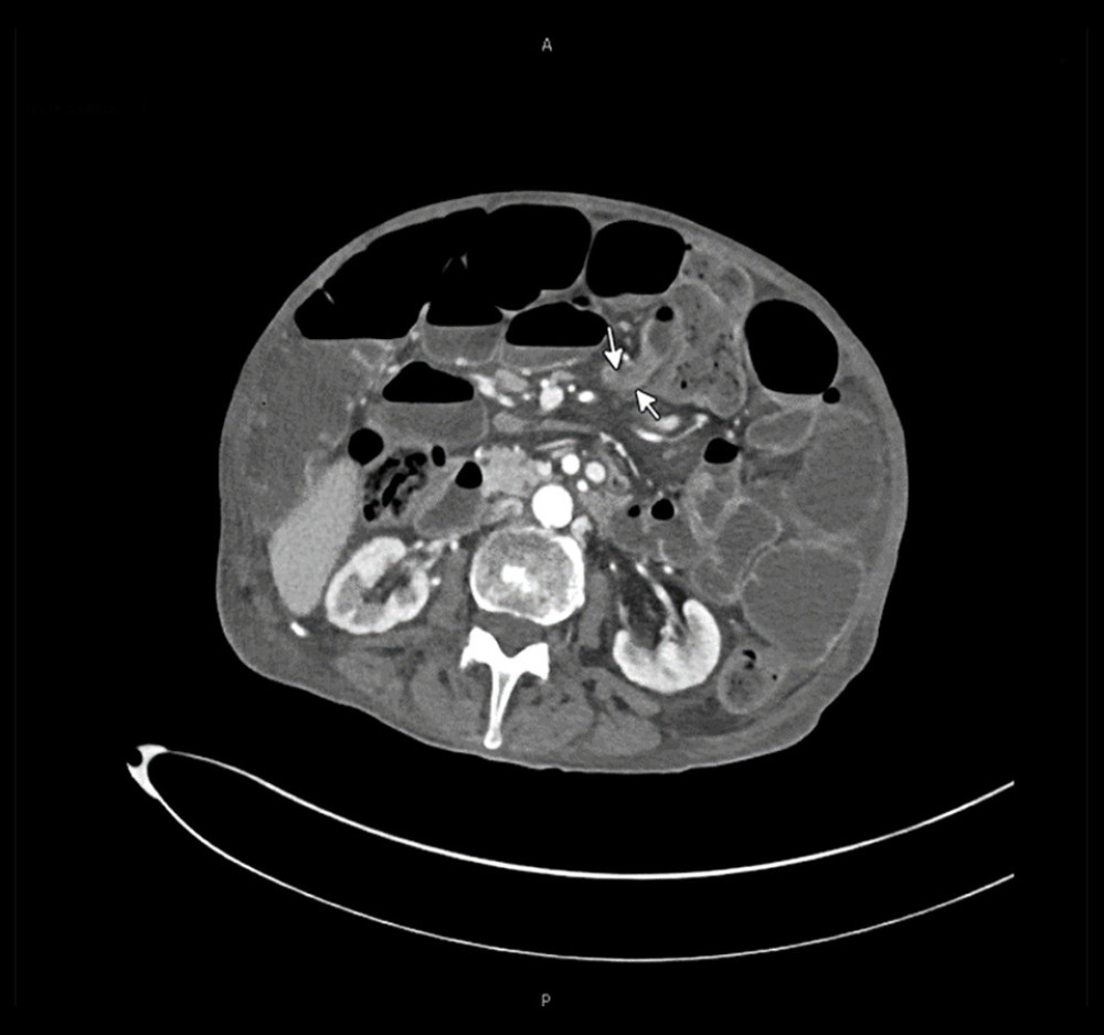 Axial view of a computed tomographic scan showing dilated loops of small bowel, with air fluid levels and a transition point in the mid abdomen indicated by the small white arrows.